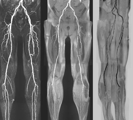 МРТ ангиография лёгочных артерий, артерий верхних и нижних конечностей